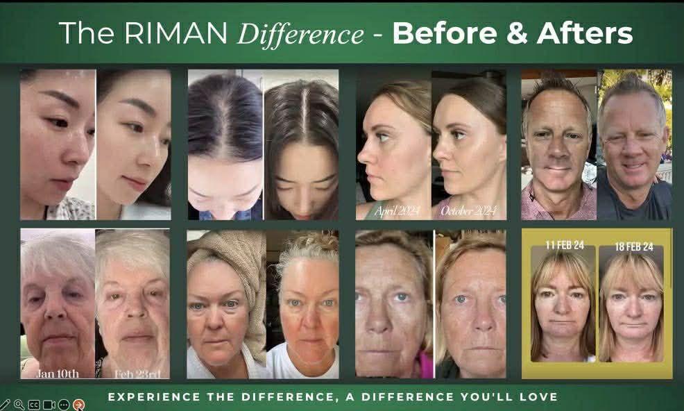 Riman before and after result