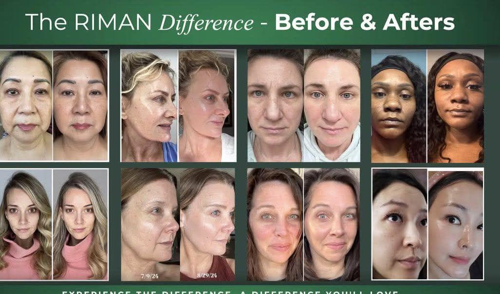 Riman before and after result